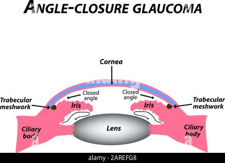 Geschlossenes Winkelglaukom. Eine häufige Art von Glaukom. Die anatomische Struktur des Auges. Infografiken. Vektordarstellung auf isoliertem Hintergrund. Stock Vektor