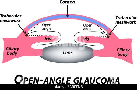 Offenes Glaukom. Eine häufige Art von Glaukom. Die anatomische Struktur des Auges. Infografiken. Vektordarstellung auf isoliertem Hintergrund. Stock Vektor