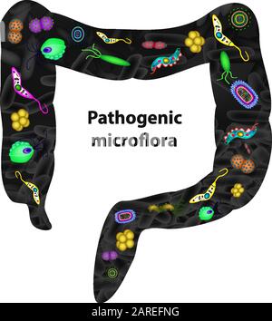 Pathogene Mikroflora im Darm. Dysbacteriose. Dysbiose. Tötete die gute Bakterienflora im Dickdarm. Infografiken. Vektorgrafiken auf Stock Vektor