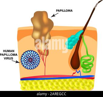 Das humane Papilloma-Virus verursacht die Bildung von Papillomen auf der Haut. Struktur. Infografiken. Vektordarstellung auf isoliertem Hintergrund. Stock Vektor