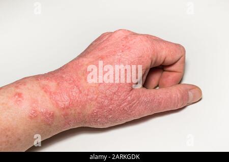 Allergische Hautläsionen der Hand mit Rissen, Entzündungen und Abblättern. Psoriasis, atopische Dermatitis, Ekzeme. Hautprobleme Stockfoto