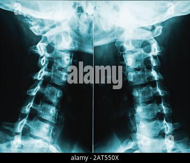 Röntgenbild oder Radiographie der männlichen Halswirbel oder Halswirbel des Menschen. Stockfoto