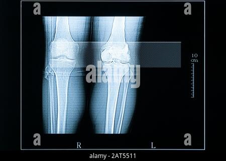 CT-Scan mit jungen männlichen (25 Jahre alt) linken und rechten Knien. Bilder aus der Medizin und dem Gesundheitswesen mit einer Skala von Zentimetern. Linkes Knie verletzt. Stockfoto
