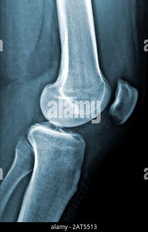Röntgenbild des linken Knies oder vertikales Röntgenbild. Bilder aus der Medizin und dem Gesundheitswesen. Stockfoto