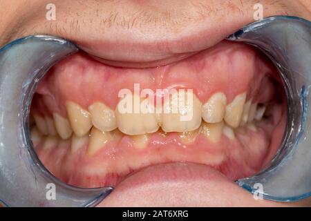 Karies. Befüllen mit zahnmedizinischen Composite photopolymer Material mit Kofferdam. Das Konzept der zahnärztlichen Behandlung in einer Zahnklinik Stockfoto