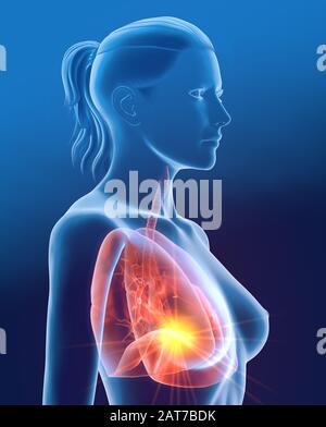3D-Abbildung mit Lungen mit Entzündung, Pneumonie Stockfoto