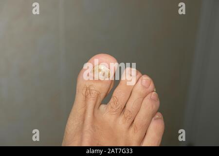 Junger Kerl barfuß Finger mit kranken Onycho Mykose Nägel, dermatologisch medizinisch Stockfoto