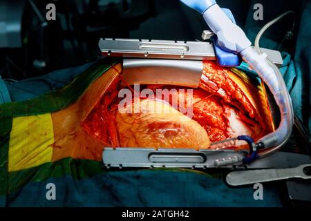 Herzchirurgie. Operation am offenen Herzen naht mehr Saphenous Vein koronarer Bypass-Operation Stockfoto