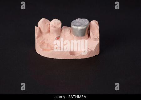 Putzgussschnitt der linken oberen Zähne aus menschlichem Männchen mittleren Alters zur Herstellung einer Zahnkrone. Provisorische Aluminiumkrone in Position. Stockfoto