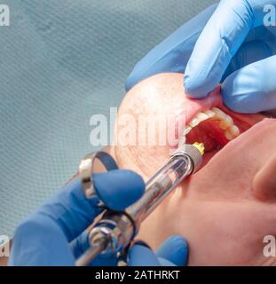 Der Arzt verabreicht dem Patienten in der Zahnklinik eine anästhetische Injektion Stockfoto