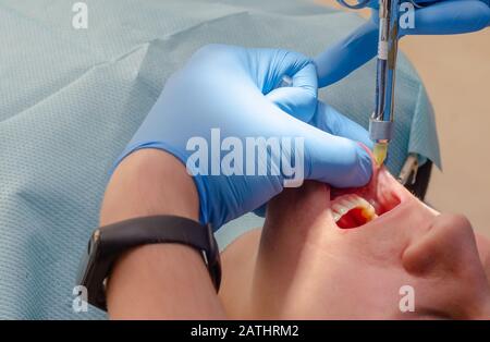 Der Arzt verabreicht dem Patienten in der Zahnklinik eine anästhetische Injektion Stockfoto