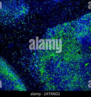 Tumor-Immunfluoreszenz-IHC-Bild der Immuntherapie. Tumorzellen in Blau werden von T-Zellen des Immunsystems grün befallen Stockfoto