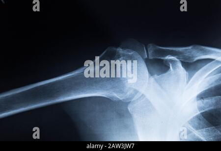Film-Röntgenschulter-Röntgenbild zeigt degenerative Arthrose der Gluten- und Akromioklavikulären Gelenke Stockfoto