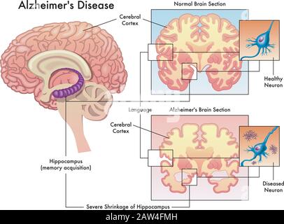 Medizinische Illustration der Alzheimer-Krankheit isoliert auf weiß. Stock Vektor