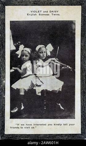 1913 Ca, GROSSBRITANNIEN: Die in Großbritannien geborenen Zwillingssöchter, Schwestern Daisy und Violet Hilton (* 1908; † 1969) als Kinder, Souvenir-Postkarte . T Stockfoto