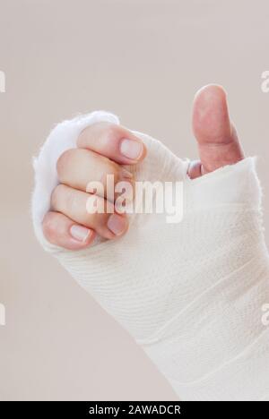 Kaukasischer Mann mit einem gebrochenen Arm in einer Splinte und einem Guss. Seine Finger sind verfärbt und geschwollen. Stockfoto