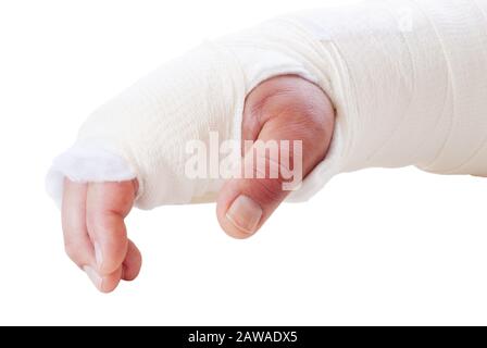 Seitenansicht des gebrochenen Arms eines Mannes in einer Besetzung. Seine Finger sind verfärbt und geschwollen. Aufnahme in Tageslicht auf weißem Hintergrund. Stockfoto