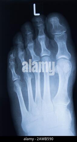 Normale Radiographie des Fußes, medizinische Diagnostik, Traumatologie und Orthopäde, Rheumatologie Stockfoto