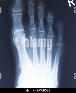 Normale Radiographie des Fußes, medizinische Diagnostik, Traumatologie und Orthopäde, Rheumatologie Stockfoto