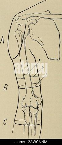 Operative Chirurgie, für Studenten und Praktiker. ^ lang, um den ganzen Stumpf zu bedecken. Die Arteria brachialis und die zugehörigen Venen sind lyinganterior und innerhalb des Knochens gefunden und sollten eingeklemmt und gebunden werden;. Abb. 327.-Rechter Arm, Anterior Aspekt. A, Umriss der seitlichen Deltoidklappe in der Exartikulation am Schultergelenk; B, Amputation durch den Arm;1, Einschnitt durch die Haut; 2, Einschnitt durch den Muskel; 3, Linie des Divisionthrough des Knochens; C, Einschnitt zur Exartikulation durch das Ellenbogengelenk (CIR-cular-Methode). Die mittleren und ulnaren Nerven, die sich in unmittelbarer Nähe zum Derbrak befinden Stockfoto