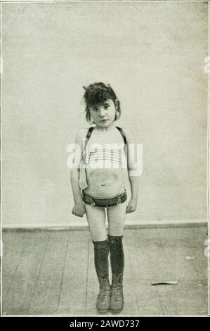 Tuberkulose im Säuglingsalter und Kindesalter: Ihre Pathologie, Prävention und Behandlung. ABB. E/A. - POSTERIORE UNTERSTÜTZUNG DER TUBERKULÖSEN ERKRANKUNG VON THEMID-DORSALEN UND OBEREN LENDENWIRBELREGIONEN das Serum hat das Interesse an der subkutanen Einführung von Tuberkulin wieder belebt. Es besteht kein Zweifel daran, dass das neue Tuberkulin heilende Eigenschaften enthält. Die schädlichen Ergebnisse sind auf eine zu hohe Dosierung zurückzuführen. Dosen für kleine Kinder von 4J .vto rW Milli-gram haben sich in vielen Fällen als sehr hilfreich erwiesen, die von einem Schreibschreiber behandelt wurden, und selbst wenn man nicht die Möglichkeit haben kann, den Index zu schätzen, wird kein Schaden folgen Stockfoto