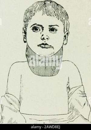 Tuberkulose im Säuglingsalter und im Kindesalter: Ihre Pathologie, Prävention und Behandlung. RE, unmittelbar nach ihrer Genesung aus der Anästhesie, werden sie ins Freiluft genommen.Das Ergebnis dieser Umgebung ist in einem gewissen Maße ermutigend, und unsere Prognose in solchen Fällen ist voller Hoffnung. Wenn wir nach unheilbaren Häusern und unseren Krüppelasylums im Trubel und Lärm unserer Städte Ausschau halten, sehen wir mit Bedauern einen großen Teil der Wirbelsäulenkinder, IS4-TUBERKULOSE IM SÄUGLINGSALTER UND KINDESALTER mit wan, pathetischen Gesichtern, die einen aussichtslosen Kampf gegen eine wohlmehende, feindselige Umgebung bekämpfen. Lassen Sie uns t erkennen Stockfoto