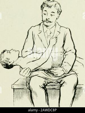 Tuberkulose im Säuglingsalter und im Kindesalter: Ihre Pathologie, Prävention und Behandlung. Man sollte den Kopf berühren oder das Kinn anheben, das das Kind schreit, aber der Kopf ist ziemlich starr. Ifdie zwei oder drei oberen Wirbel sind erkrankt, der Kopf wird wie im Wry-Nacken zu einer Seite verdreht, ein oder beide Mastoide sind starr (Abb. 2).Wenn die Krankheit niedriger ist, wird das Kinn vorgerückt und in Richtung des Brustkorbs abgesetzt, und eine Winkelprojektion am Krankheitspunkt wird auf TUBERKULOSE DER WIRBELSÄULE J79 hingewiesen (Abb. 3). Wenn die Krankheit immer noch geringer ist, wird das Kinn angehoben und der Kopf zurück zum r geworfen Stockfoto