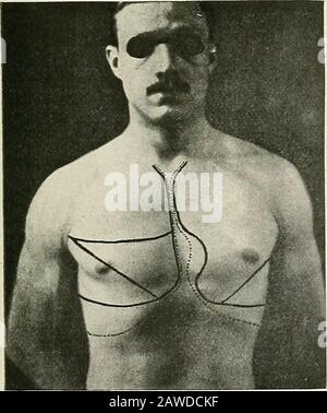 Erkrankungen des Brustkorbs und die Prinzipien der körperlichen Diagnose . Abb. QG Zeigt einen markanten Winkel von Louis, auch kleine Bereiche der absoluten Herz- und Leberdulheit bei einem Fall von Emphysem. Stockfoto