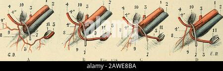 Traité d'Anatomie humaine. Br. Transversale ou iliaque. Variétés. - 1 ïronc de liliaque externe. - Jai vu dans un cas (microcéphale) riliac[ueexterne descendre dans le petit bassin et remonter vers lanneau crural, après avoir décrit unelongue courbe à cavité digigée en haut. - On la vue fournir accidentellement: Tilio-lombaireou dautres branches de liliaque interne (elle suppléait cette dernière dans deux cas), une cir-conflexe iliaque accessoire, locturatrice ou un rameau anastomotique pour cériette artère, unesous-cutanabée, condominale, la condominale, conformale, conformale Stockfoto