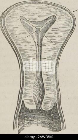 Ein System der menschlichen Anatomie, allgemein und speziell . nd transvers nach der Geburt, das os uteri, vor und hinter von twolabia begrenzt; das vordere Labium ist themostdick, und das hintere etwas - was das längste ist. Die Öffnung des Uteri ist von erheblicher Größe, Und das Orivicium uteri externum genannt; der Kanal wird dann verengt, und am oberen Ende des Cervix wird in eine kleinere Öffnung, das Orivicium internum, verengt.^ An diesem Punkt dehnt sich der Kanal des Cervix in die theshlow-dreieckige Uterushöhle aus, der dem inferioren Winkel, der dem Orivicium internum entspricht, und dem Stockfoto