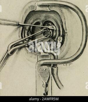 Verfahren der Connecticut State Medical Society .. . Verwendete Instrumente. Zweiter Schritt. Stockfoto