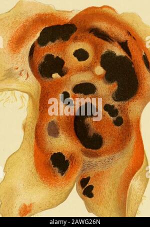 Die Ursachen und die Behandlung von Abtreibungen. Geben Sie den minuziösen Blutgefäßen die richtige Unterstützung, daher die ruptureund Extravasation. Es kann Erkrankungen des Herzens, der Leber und der Nieren, Pneumonie, Pleurisie, anstrengende chronische Krankheiten, Fieber und einige Uterus- und Eierstockbeschwerden begleiten. Eine Verletzung durch einen Schlag oder eine plötzliche Schrumpfung der Gebärmutter als Frommschlag kann diese verursachen. Verdier sagt, dass die Faserveränderungen innerhalb der Plazentae getroffen wurden, nur auf eine Extravasation des Blutes zurückzuführen sind und dass sich daraus Änderungen ergeben. Bustamente, der 1848 zu dieser Subjektin schrieb, hielt fest, dass die Blutmassen nicht auf einen Bruch zurückzuführen seien Stockfoto