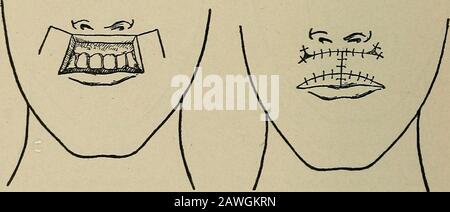 Operative Chirurgie, für Studenten und Praktiker. Abb. 132.-Die Klappen sind vom oberen Kieferknochen liberatedFrom und werden DrawnDown eingesetzt und Gesäugt. Theraw-Raum auf beiden Seiten der Nasis mit Naht geschlossen. Wenn die Klappen leicht abgenommen sind, kann der gesamte Defekt umgeschlossen werden. Der große Nachteil dieser Methode ist, dass die neue Lippe an ihrem freien Rand und der hinteren Oberfläche nicht von der Schleimhaut verdeckt wird und schrumpft und kontrahiert, während sie zikatriiert. Abb. 133.-Bruns Methode von RestoringUpper Lip. Eine quadratische Klappe, die von der Wange genommen wurde. Abb. 134.-Klappen werden nach unten gedreht Stockfoto