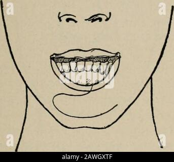 Operative Chirurgie, für Studenten und Praktiker. Abb. 126.-Klappen Nach Unten gedreht und mit Joined zu Neuem Lip. Über dem freien Rand der neuen Lippe ist die Schleimmmbranne suturd. Der Defekt an jeder Seite der Wange wird durch Naht geschlossen, Defekte auf beiden Seiten werden mit Nähten verschlossen. Im männlichen Thescar versteckt sich der Bart. Bruns-Methode.-Für einen viereckigen Defekt der Unterlippe. EINE eckig-kornierte Klappe wird von beiden Seiten des Gesichts, einschließlich der OPERATIONEN AN DEN LIPPEN, genommen. 199 und diese werden durch einen Winkel von neunzig Grad in den Fehler hinuntergedreht. Diese Stockfoto