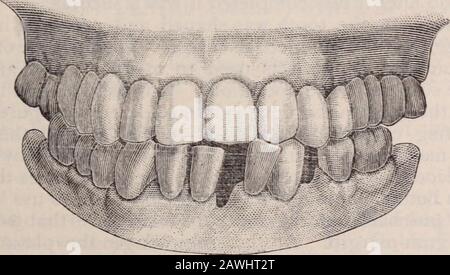Zahnkosmos . 26 ist ein Modell des Unterkiefers, das die Regelmäßigkeit der Unterzähne und Fi^ anzeigt. 27 der Fall im Verschluss. In der Behandlung dieses Falles Abb. 27.. Wir haben die Pulps zerstört und feste Kronen für den überlegenen Mo-lars hergestellt; wir krönten auch die überragende rechte Spitze und die Brücke als 294 DAS DENTAL-COSMOS. Konstruiert ist ein Stück Mechanismus, der dem Patienten einen magischen Schleifapparat gibt, und der sich als positivste Thatbridge-Arbeit erweist, ist unverzichtbar. Die eigenartige Artikulation ist in der Abbildung sehr langsam. Die kleine Brücke auf der linken Seite haben wir viele Jahre gemacht, si Stockfoto