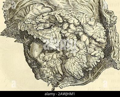 Ein chirurgischer Eingriff: Theoretisch und praktisch . etwa drei Zentimeter vom Rand des Anus entfernt, in der vorderen Wand des Rektums, wahrscheinlich aus dem submucouscellulären Gewebe. Es ist rund in Form, circa-scibed und prominent, und über das sizeof an Orange. Die Büschel oder Prozesse sind sehr gut entwickelt. Der Tumorso behinderte die Darmhöhle, thatfast die vollständige Retention des Kot wieder sultiert, und der darüberliegende Darm war sehr muchdistiert. Die Blase war durch die erkrankte Masse viel pressedupon. Es war unvoreinlich zu sagen, wie lange die Krankheit sich verengt hatte, aber es war nicht Stockfoto