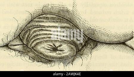 Ein chirurgisches System: Theoretisch und praktisch . in Aussehen und Struktur verändert, wie wenn es im Kind vorkommt, aber der Tumor hat eher eine globuläre Form. Der häufigste Zustand, in dem ein Rektumprolapsus zu sehen ist, besteht darin, dass eine oder zwei seitliche Falten der Membran, die von einer bis zwei Inchesinlänge variieren, aus dem Anus herausragen oder ein ungebrochener Ring aus vorstehender Membran issenen ist - aber dies ist seltener. Wenn die Krankheit nicht lange existiert hat, ist die Membran nicht viel verändert im Aussehen, ist nur etwas verdickt und vaskularthan natürlich; aber sollte der Darm haben Stockfoto