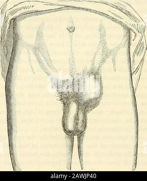 Ein chirurgisches System: Theoretisch und praktisch . RE leicht im direkten Leistenherniathan in Schräge. Bei der Augenuntersuchung aus kurzer Entfernung wird es seendass eine Linie, die durch die vertikale oder lange Achse des Tumors verläuft, parallel zur Linea alba liegt, Und es scheint keine Neigung oder Verwölbung des Ausschnitts des Tumors nach außen und in Richtung des Scheitels der Ilium zu geben, wie es in einer Form von schrägen Leistenbeinen beobachtet wird. In seiner Passage vom Bauch durchläuft eine direkte Hernie lediglich den kleinen Teil des Leistenkanals, der unmittelbar hinter den äußeren Leistenalri liegt Stockfoto