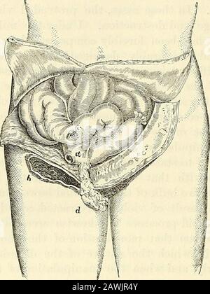 Ein System der Chirurgie: Theoretisch und praktisch . Wände des Röhrchens werden zerstört, was zu entsprechenden Ergebnissen führt. Ich bestünde, dass nach dem Fiisten-Unfall die Reparatur des Lochs freizügig stattfindet, dass der Taumellauf der ganzen Zahl perfekt heilt und es zu einer vollständigen Genesung kommt. Nach dem zweiten ist die Prognose jedoch nicht so günstig; für gewöhnlich ist der ankünstliche Anus dauerhaft etabliert, und mehr oder weniger der Inhalt der thealimentarischen Röhre wird hierhin abgeleitet. Als Folge der lang anhaltenden Verengung durch den Mund des Sacks und des Drucks auf die beiden unstringenden Teile Stockfoto