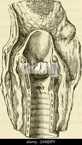 Ein System der Chirurgie: Theoretisch und praktisch . Fibromata oder faserige Grov^die Falter werden im Kehlkopf deutlich seltener als die papillösen Growths oberhalb von desci^ibed, aber zahlreiche Fälle sind zu verzeichnen. Diese Growths sind in der Regel oberflächlich glatt, hemisphärisch, globulär, orpyri-förmig, und bei der laryngoskopischen Inspektion erscheinen sie etwas 2:)aler incolor als die Schleimhaut der umliegenden Teile, sind aber etwas hellrot. In der Substanz sind sie mehr oder weniger fest und kompakt. In der Struktur ähneln sie den in anderen Teilen entwickelten Gi-Eowths ähnlicher Natur; als r Stockfoto