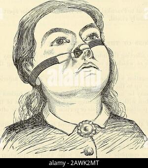 Ein System der Chirurgie: Theoretisch und praktisch . Während der andere Haken in den äußeren Anglerbereich der nasalen Apertiu-e eingesetzt wird. Die Menge der Dilatation kann durch Anziehen oder lösen des elastischen Bandmittels der Schnalle be-hind bereguliert werden; und die Haken, bis zu einem gewissen Grad flexibel, können ihre Kurve für einzelne Fälle alteiedum sein. In einigen Fällen^ kann, wie von Czermak überlastet, ein kleinovaler Spiegel verwendet werden, der im Winkel u]3auf einem langen Schlenkelstiel montiert ist und einen großen Vorteil bietet. Wenn ein solcher Spiegel in eine größere oder weniger Tiefe durch das Nasenloch eingeführt wird, leuchtet er perlig, so wie er ist Stockfoto