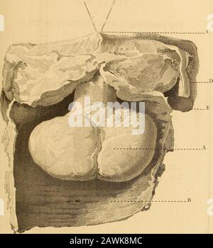 Beobachtungen zu den Erkrankungen von Frauen, an denen ein Verchargeenillustriertes Kupferblech der Krankheiten &c teilnahm. 1814. ERLÄUTERUNG DER PLATTEN. 341 PLATTE VII Eine posteriore Ansicht derselben Vorbereitung. A. Zeigt einen Abschnitt des karzinomatösen Muskats, von dem ein Teil nur in Platte VI enttarnt werden konnte B. Der Modus der Gebärmutter. Da die Größe dieser Zeichnung nicht die tatsächliche Größe der Zubereitung übererreicht, ist es offensichtlich, dass alle Teile der Gebärmutter einen Untergonomgrad der Vergrößerung aufweisen. 342 ERLÄUTERUNG DER PLATTEN, PLATTE VIII Diese Gravur zeigt einen Polypus der Gebärmutter. Stockfoto