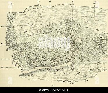 Ein System der Chirurgie: Theoretisch und praktisch . KIA. 563 koaleszierender, eventviall) foi-ra beachtlicher Plaketten, die zu diesem Zeitpunkt eine blassbläulich-weiße oder tote-weiße Farbe aufweisen. In diesem Stadium sieht die Zunge so aus, als sei sie über bestimmte Bereiche mit Silbernitratlösung angeraut worden; die Oberfläche ist hier aber noch weich und eben. Solange sich um diese weißen Flecken eine enge Grenze des Erythems befindet, können sie als auf dem Anstieg betrachtet werden; wenn dies nicht vorhanden ist, ist das aktive Wachstum zum Erliegen gekommen. Später, dann, können die Plaketten gräulich-weiß oder manchmal auch gelblicher werden Stockfoto