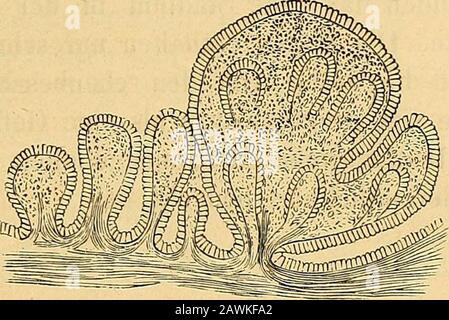 Diagnose, Pathologie und Therapie der Frauen-Kranken. Von Röhren oder Drüsen, Zusammen-nürung derselben an gewissen Stellen; deren Resultat Höhlenoder Cystenbildung innert halben des Drüsengewebes Fox ist, analog erschein.Es scheit, dass Billroth in ge von der Lage ist, sich an den Schildern zu halten. Es ist eine sehr ähnliche, röhrerische Struktur, die in Ovarialcysten nur für den einen oder den zweiten Platz geeignet ist. Dassdem so sei, hassen Foxs Untersugungen bewiesen. Seiner Ansichtnach soll diese Ovarialgeschwülste, welche Drüse Stockfoto