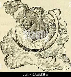 Ein System der Chirurgie: Theoretisch und praktisch . Abb. 61.-Elfenbein-Exostose, die wegen ihrer großen Härte erfolglos vereitelt wurde. Die Peeling wurde durch die lange Anwendung von Ätzstoffen - vor allem von Nitricsäure - nach den Stationen erzeugt. (Vom Museum des St. GeorgesHospital, Serie ii Nr. 189.). Behandlung: Die langsame Rate, mit der sich der Fortschritt der Exostosen erhöht, und die Leichtigkeit, mit der sich diese weichen Teile dem gTadual-Fortschritt des Tumors unterbringen, machen es häufig überflüssig, sich mit ihnen zu mischen; und es ist immer richtig, die Operation zu verschieben, bis man sie eindeutig als Nische erkennt Stockfoto
