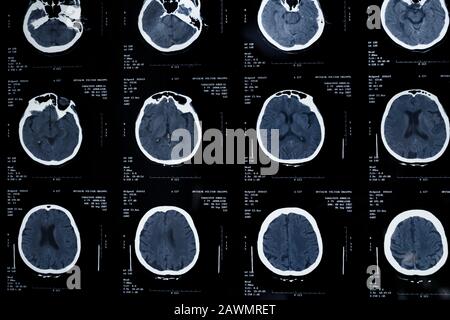 Bilder aus einer computerisierten Tomographie des Gehirns Stockfoto