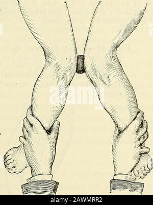 Ein System der Chirurgie: Theoretisch und praktisch . fordert das Kind auf zu gehen. Sometitimeswe kann die Liegehaltung auch in kurzen Tageszeiten vorteilhaft empfehlen, und kombiniert damit das Auflegen eines weichen Vorhängers zwischen den Kondylen, die verlängerten Gliedmaßen und die Knöchel, die sich durch einen weichen Verband, einen Riemen oder eine andere Ligatur leicht zuziehen, Oder durch die Hände des Chirurgen oder des von ihm unterrichteten Rvibbers (siehe Abb. 37 und 38). Die langjährige Erfahrung hat uns gezeigt, dass zwei Dinge unentbehrlich sind - zum Bild. 37 steht für a Stockfoto