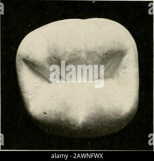 Technik und Umfang von Gussgold- und Porzellaneinlagen; mit einem Kapitel über Endokrinodontien oder die duktlosen Drüsen - ihre Expression im menschlichen Mund . Y 1 Abb. S9. Fia-. 90.. Stockfoto