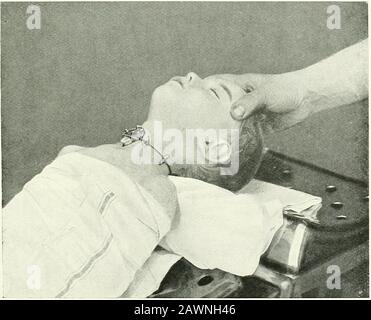 Chirurgische Therapeutika und operative Verfahren . y^-- Abb. 366.-Tracheotomie IX die erste und zweite Stufe des Kindes. Abb. 367.-Tp.acheotomie bei Kleinkindern.Die Operation wurde abgeschlossen. Ein Docht Gaze ist unter Tlüschkanüle gerillt. 228 CHIRURGISCHE THERAPEUTIKA UND OPERATIVE VERFAHREN Stockfoto