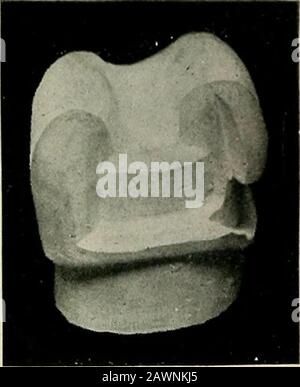 Technik und Umfang von Gussgold- und Porzellaneinlagen; mit einem Kapitel über Endokrinodontien oder die duktlosen Drüsen - ihre Expression im menschlichen Mund. Fio-. 01. Abb. 62. Abb. 63. Stockfoto